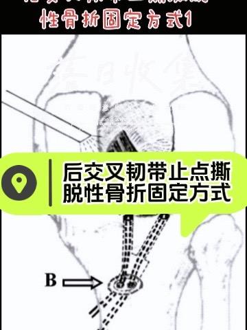 后交叉韧带止点撕脱性骨折固定方式。随着关节镜技术的发展，越来越多的手术...
