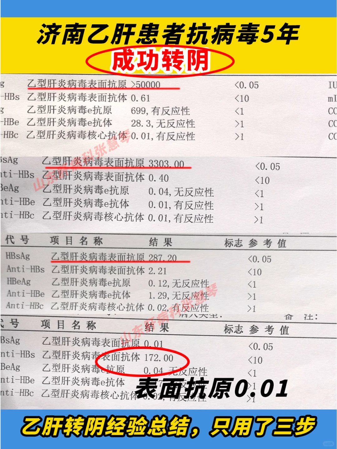 济南乙肝患者从乙肝到转阴，只用了三步→