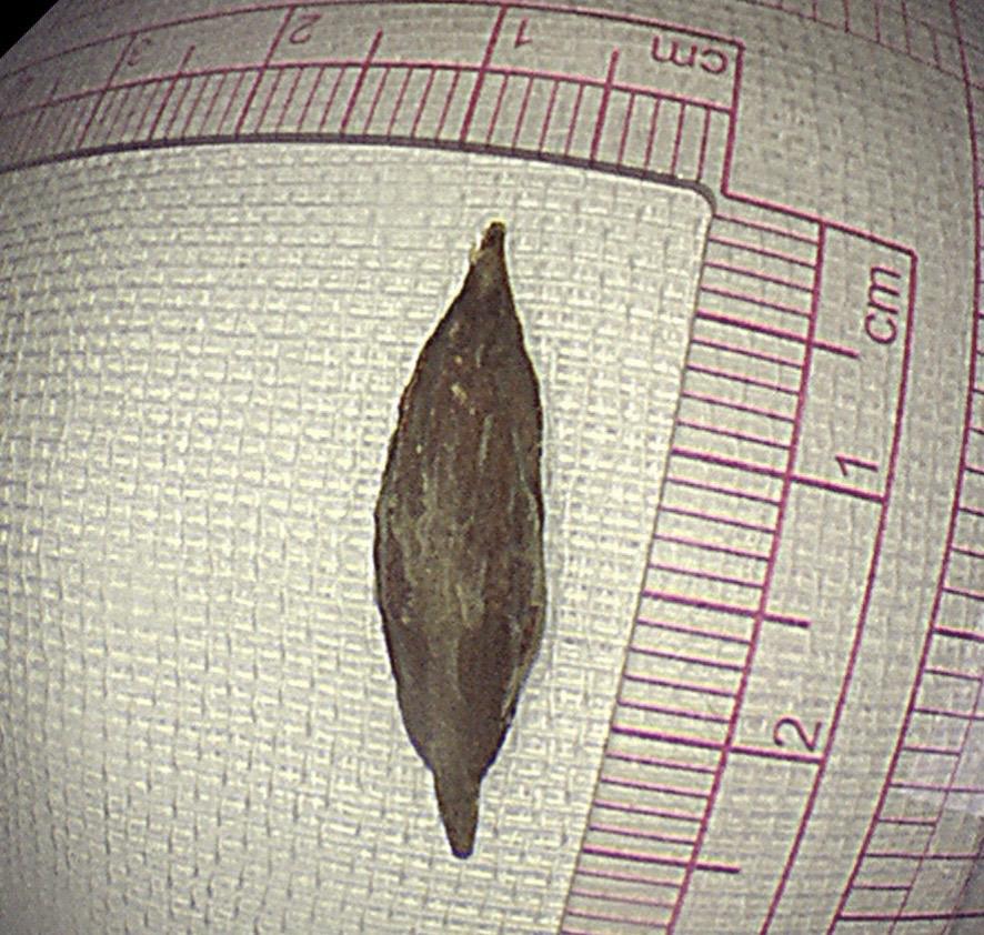 取枣核发现个早癌！这个枣核虽然代价有点大，但能够发现早癌并完整切除也值了！