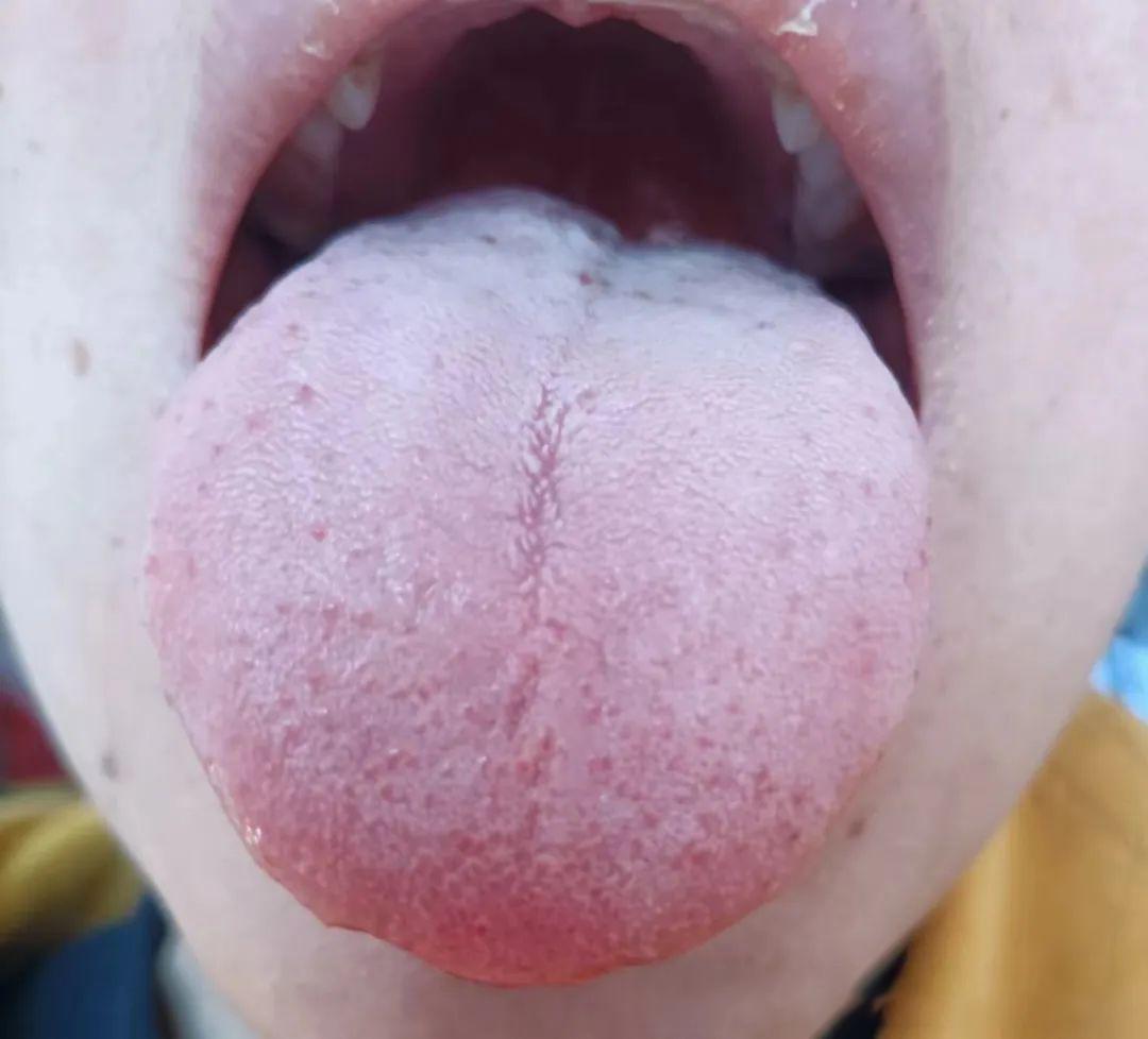 一到春天，过敏性鼻炎的患者就急剧增多
今天潘医生，教你如何通过舌象辨证，鼻炎患者