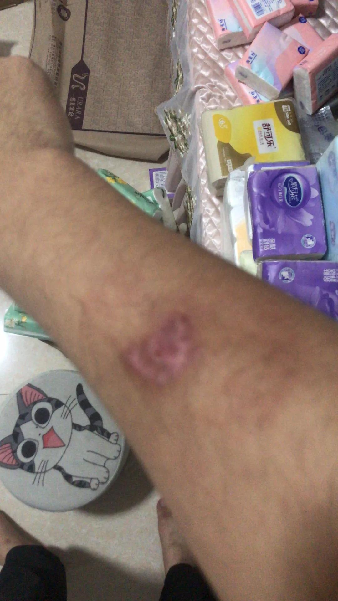大家来猜猜这是被什么东西咬到了[捂脸]，千万别惹母老虎！