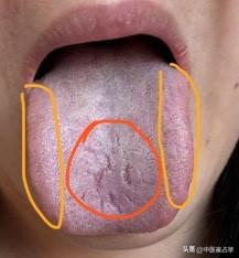 舌诊实战分享：
病人主诉：嗓子有异物感、乏力、胀气
舌象分析：
肺气亏虚—舌面前