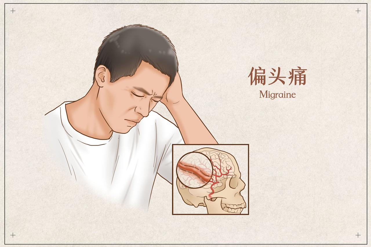 #健康真探社#【为什么越来越多人都有偏头痛？】头痛是常见问题，一般人群的偏头痛发