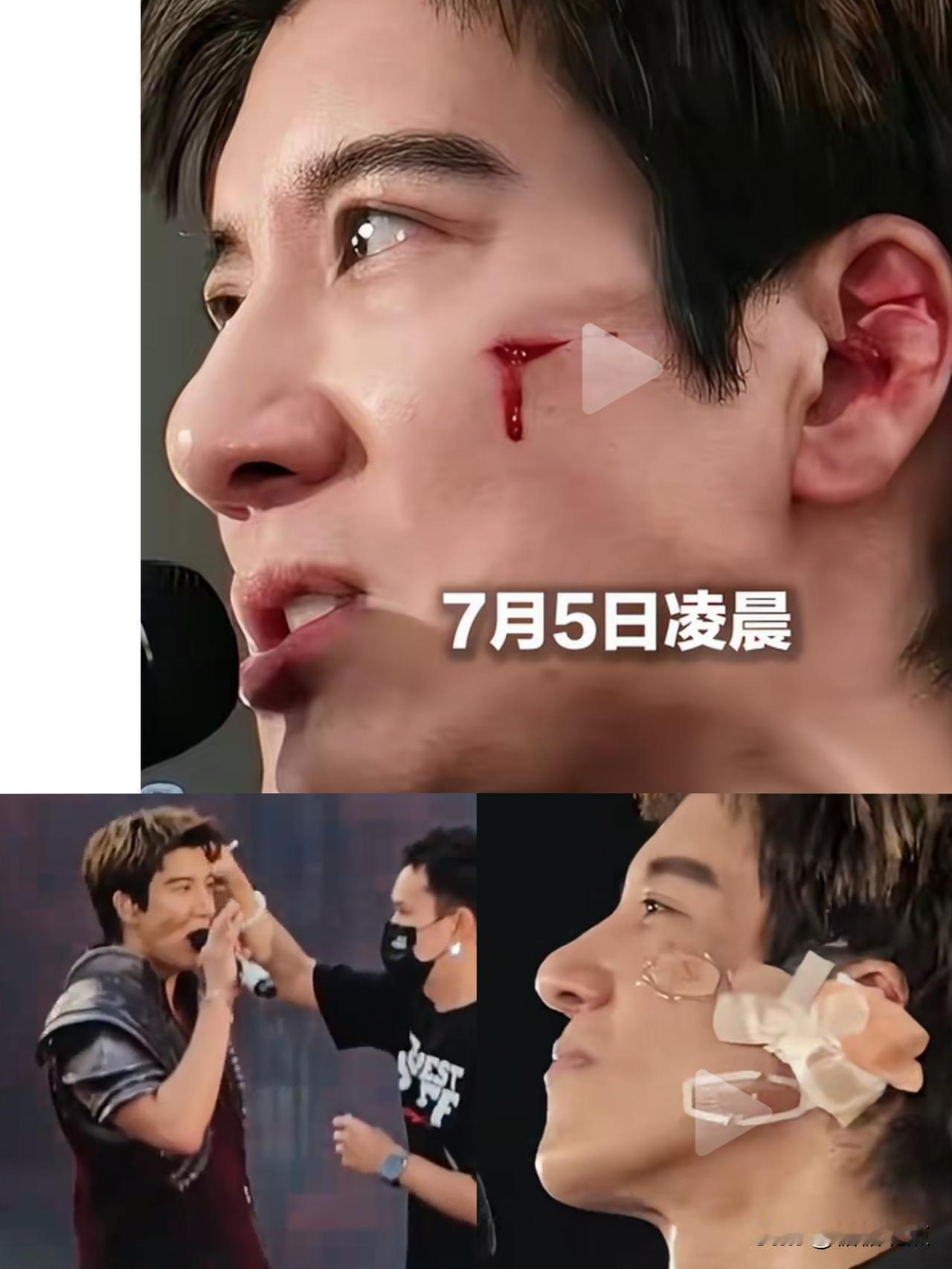王力宏开演唱会缝了39针！这个怕是有点痛哦。
可为什么还有那么多人说他是故意的？