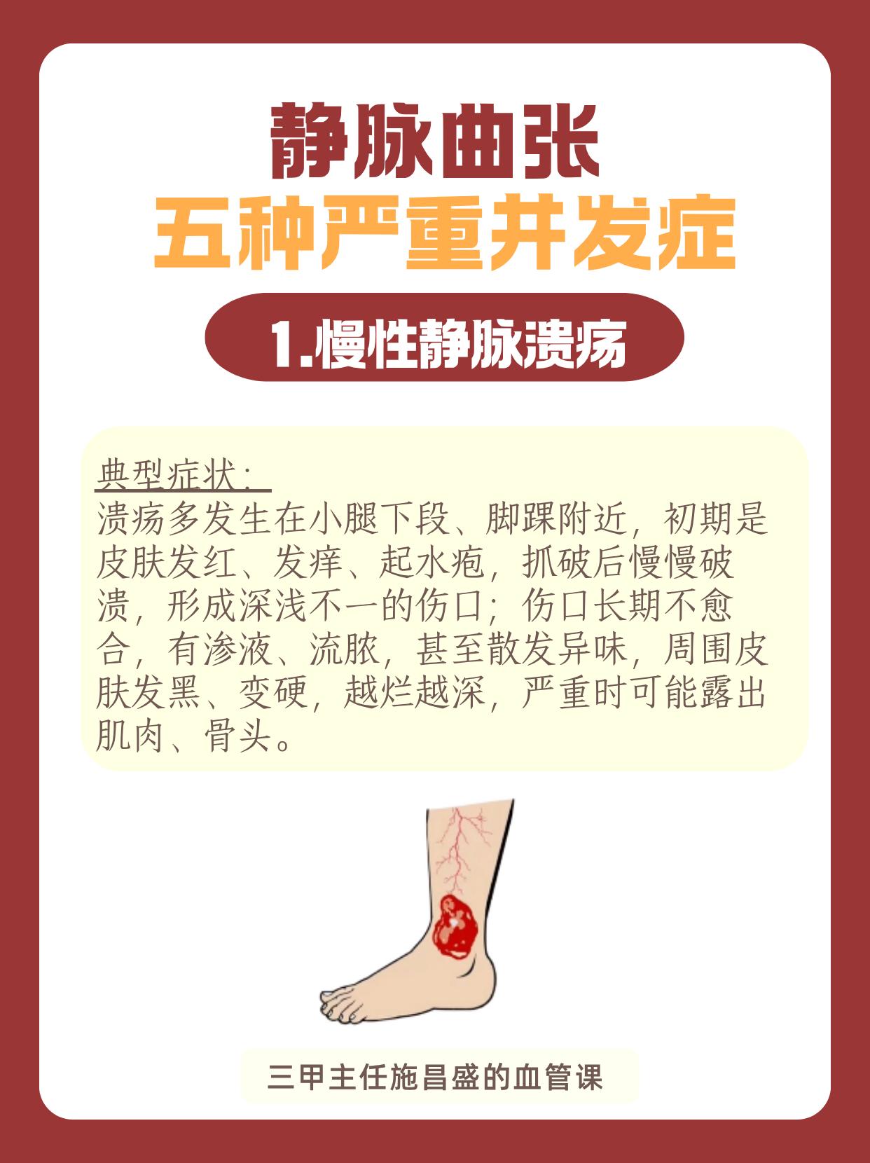 静脉曲张的五种严重并发症。很多人觉得静脉曲张只是腿上 “青筋凸起”，影...