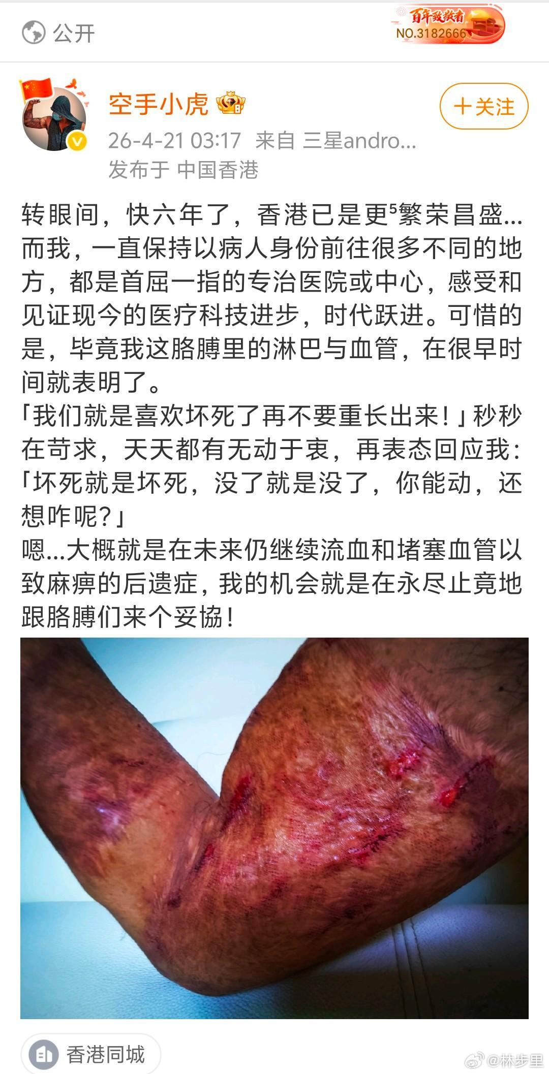黑暴时期，国庆执勤被泼上腐蚀性液体，造成胳膊严重创伤的香港警察。当英雄的伤再也不