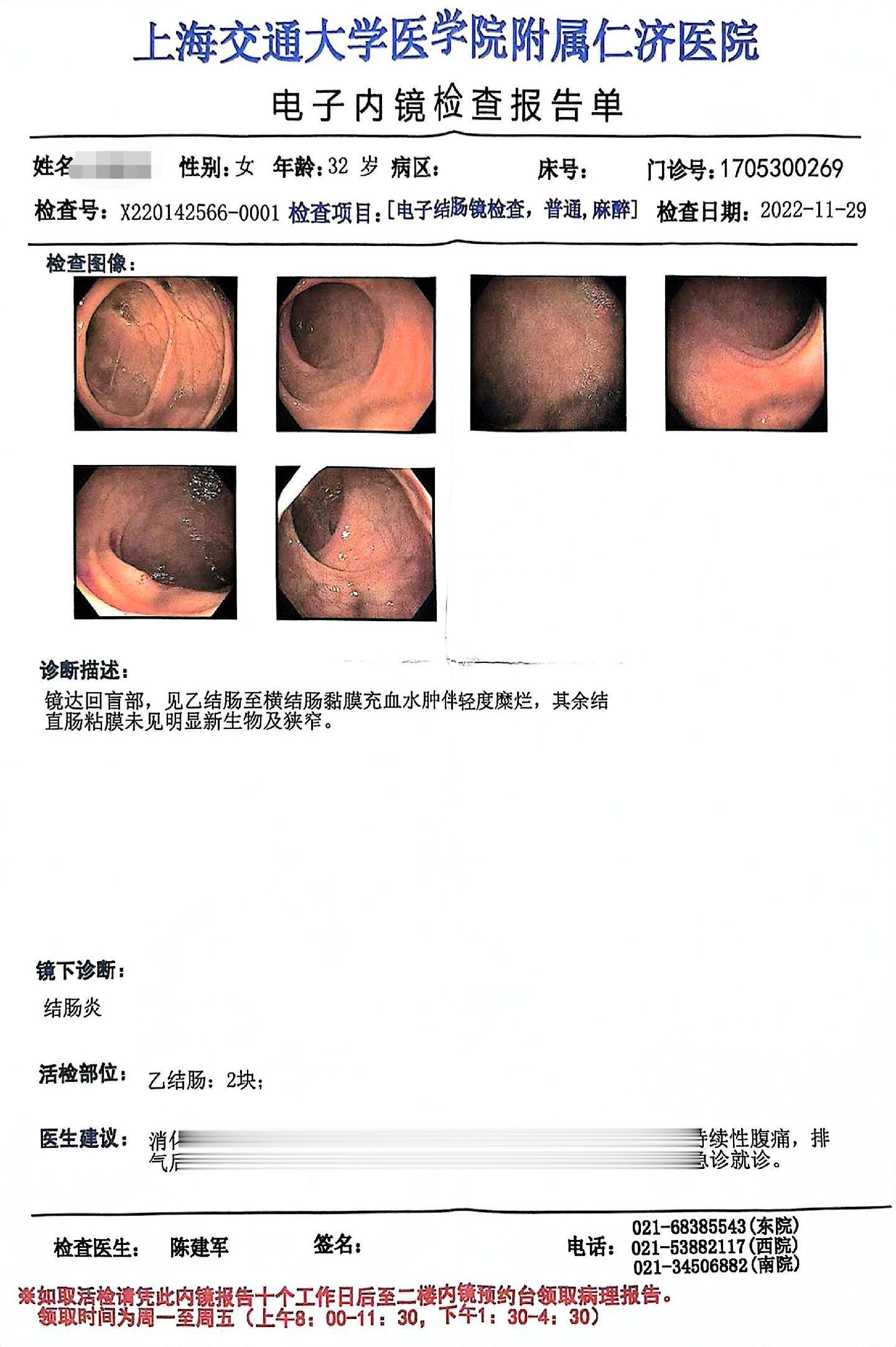 疾病随着时间的推移慢慢典型确诊。
这位姑娘，22，23并没有确诊溃结，因为不典型，她没有直肠部位病变，但是从23年降结肠的肠镜表现，已经可以看出有溃结的影子。这次患者便血明显，前来就诊，复查肠镜，明确诊断，广泛结肠中度活动的溃结。即日是她美沙拉嗪不规律的吃着，还是逐渐在进展。
