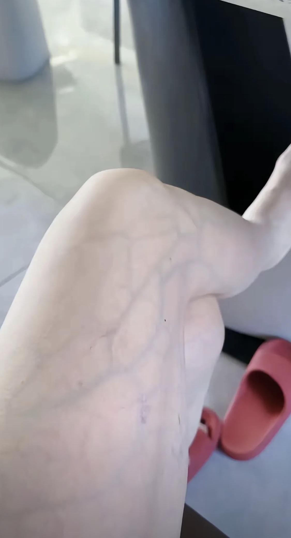 这是静脉曲张吗？