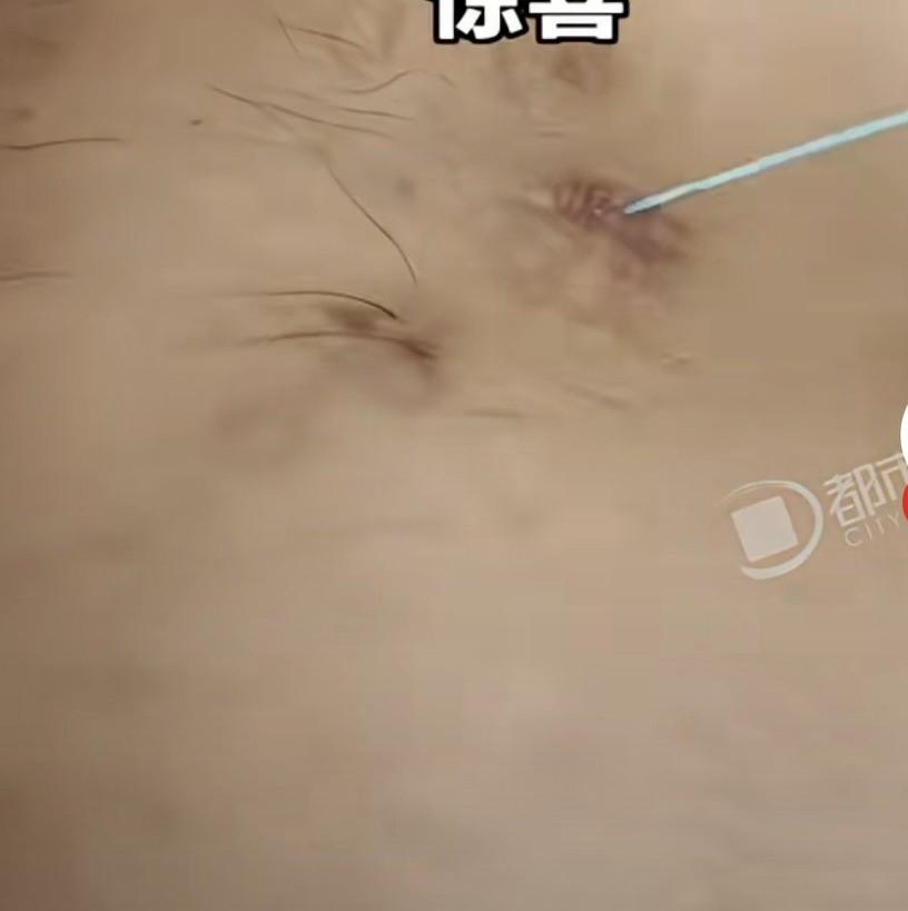 男子说术后七个月给了我一个大惊喜，术后七个月从伤口薅出线头，
男子从自己的腿部有