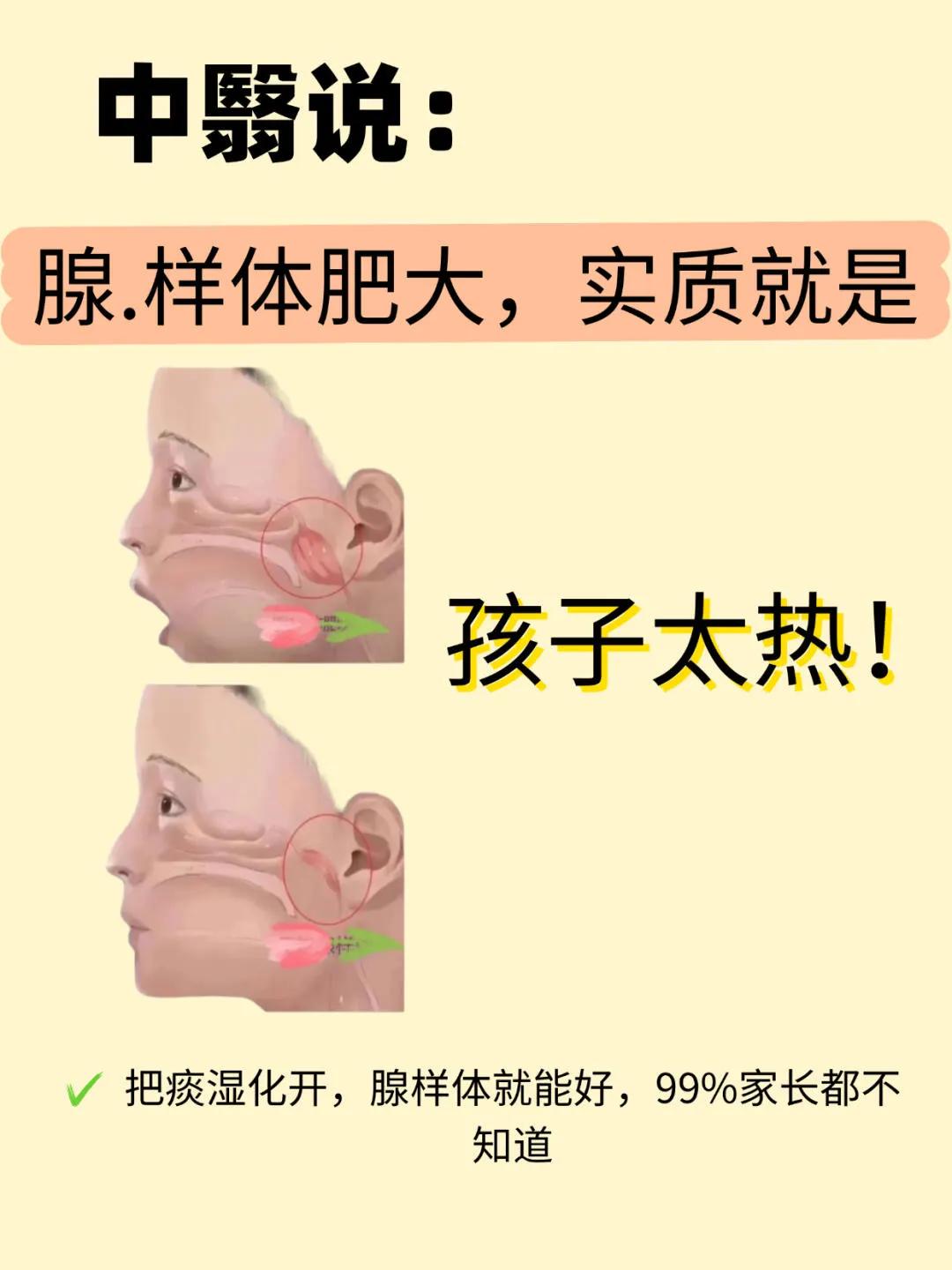 孩子腺样体肥大不要慌，手把手教你怎么做❗4岁腺样体肥大 
现在很多人都有「容貌焦