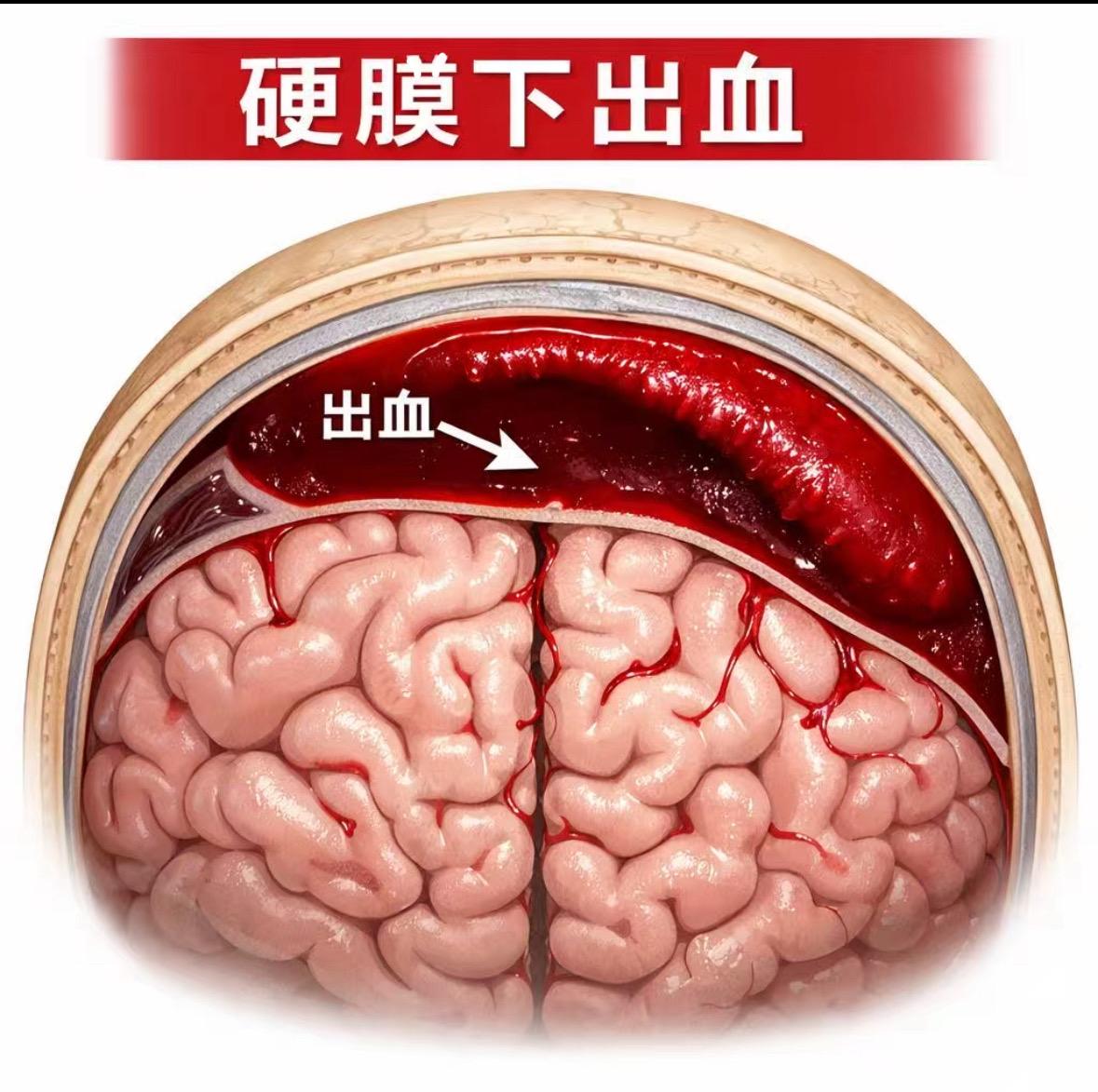 你会怎么选择？年龄是一道无法逾越的坎，80岁脑出血的被选择，真实世界的...