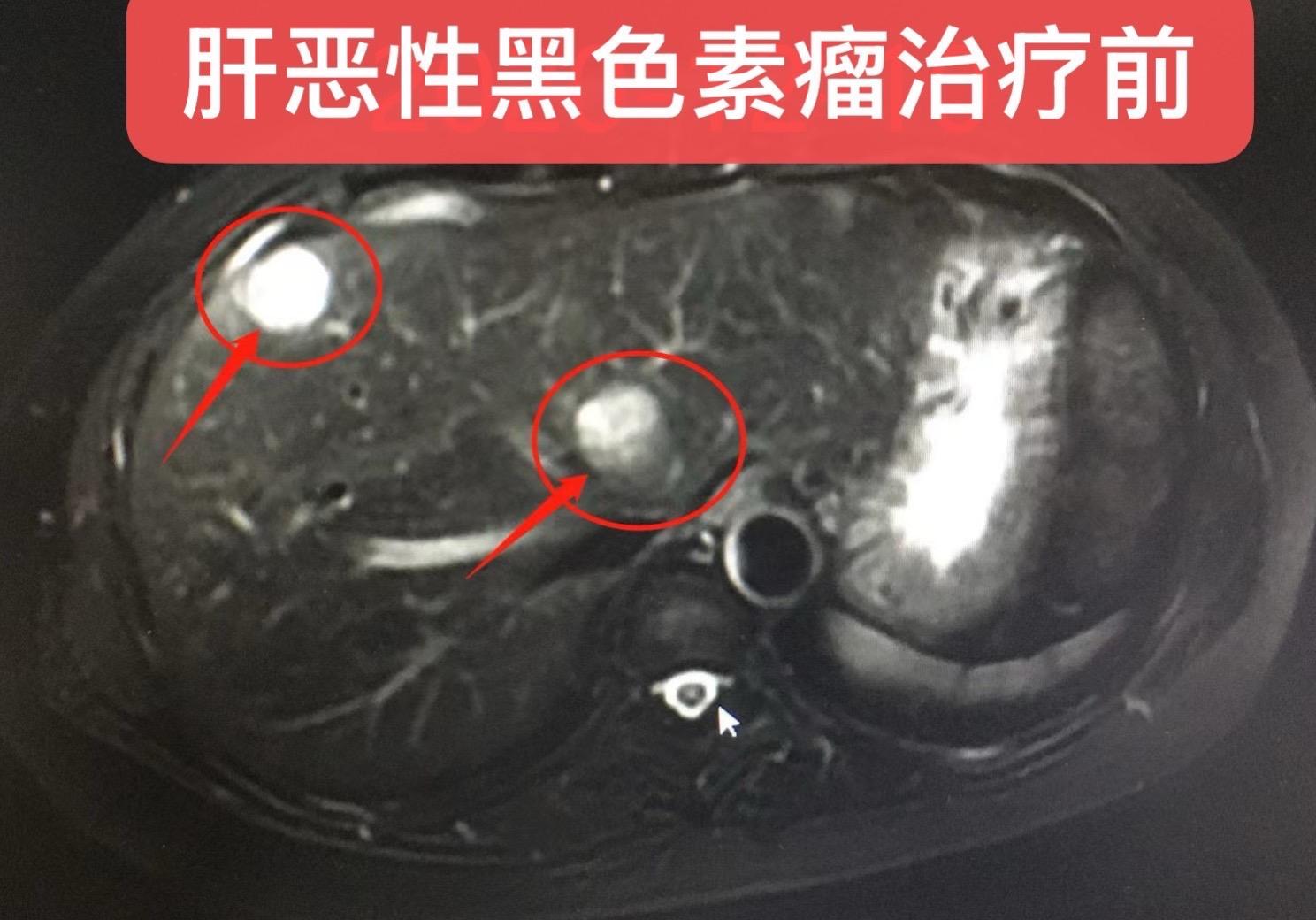 肝恶性黑色素瘤转移。基因检测无特异性靶点，病灶数量多，难以手术，采用抗...