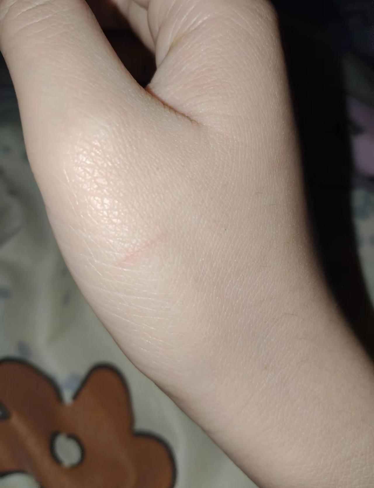 我说在床上躺着怎么感觉手痒痒的痛痛的，啥时候划伤的，毫无印象毫无感觉，只觉得现在
