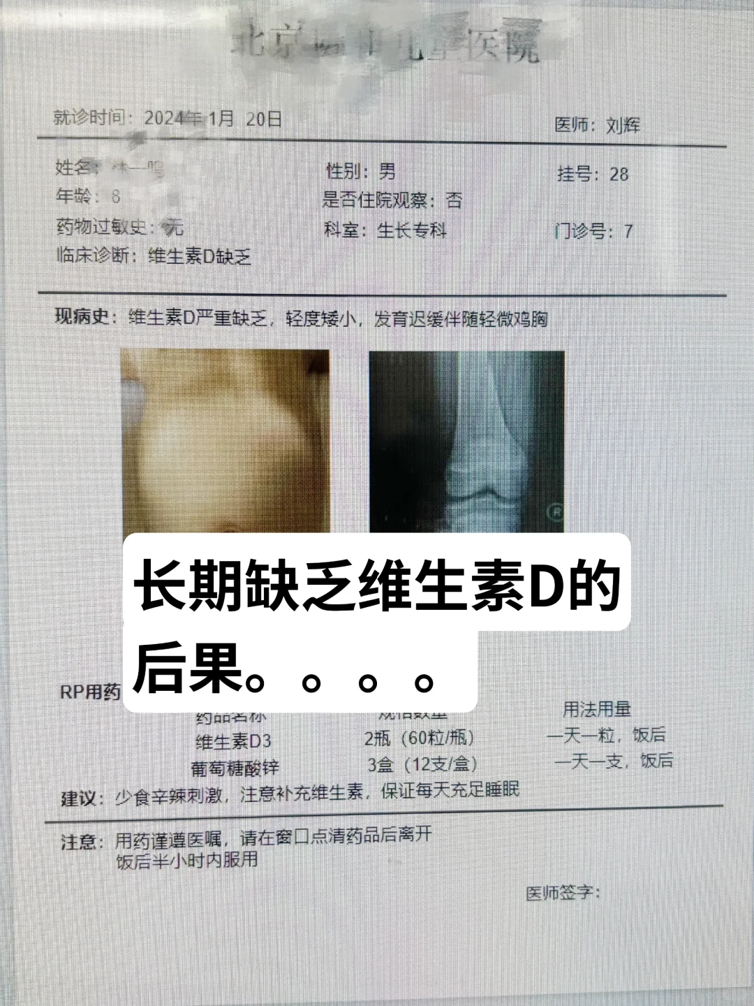 长期缺乏维生素D真的会影响发育‼️