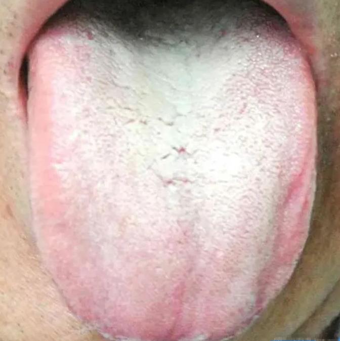 舌苔白厚腻，舌两边发红，你是不是也认为首先应该祛湿化痰、清热降火？
     那