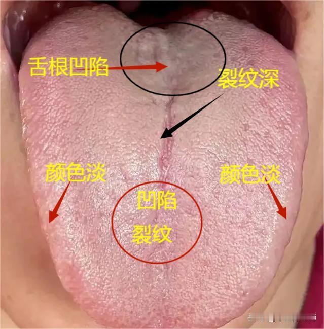 从舌质辨健康，你能看出哪里都有什么问题吗？

1、脾胃不好在舌中

2、肾气亏虚