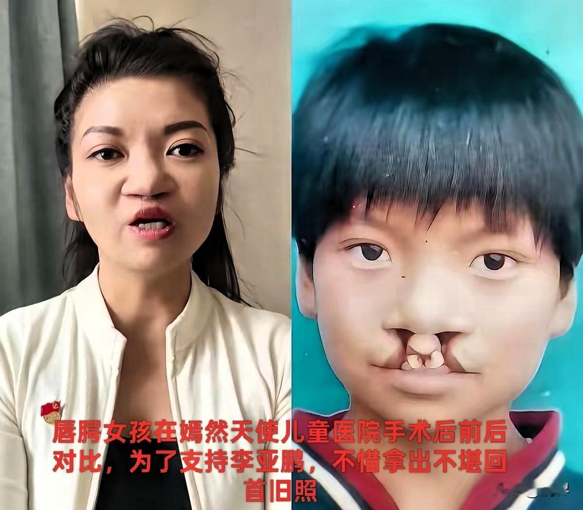 真是世态炎凉？
深夜刷到一个女孩，她曾是重度唇腭裂，虽经修复但说话仍有些漏风。为