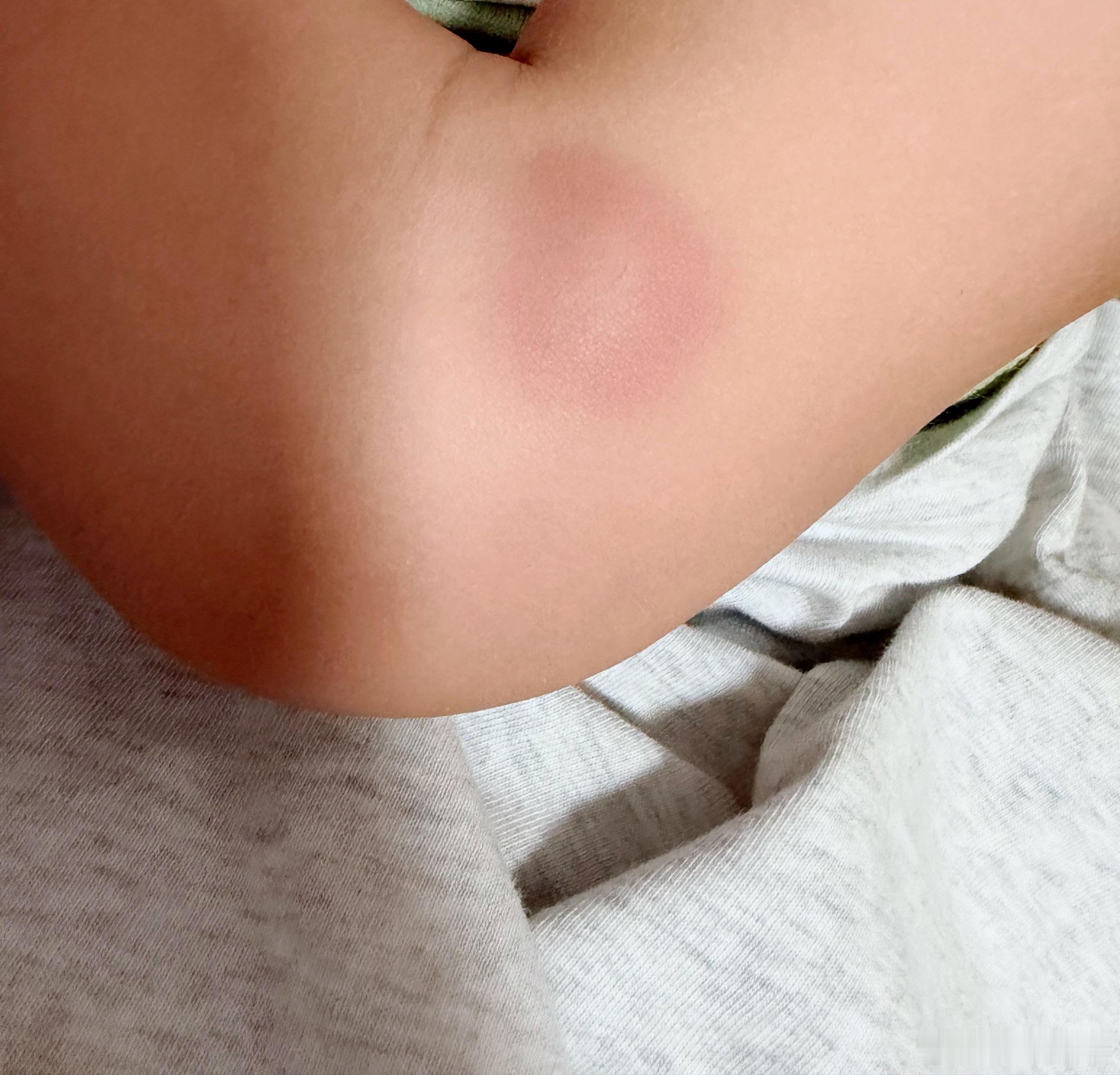 早上醒来喝奶，娃外婆他的腿不知道被什么咬了，查了一下大概率是蚊虫叮咬后的虫咬皮炎