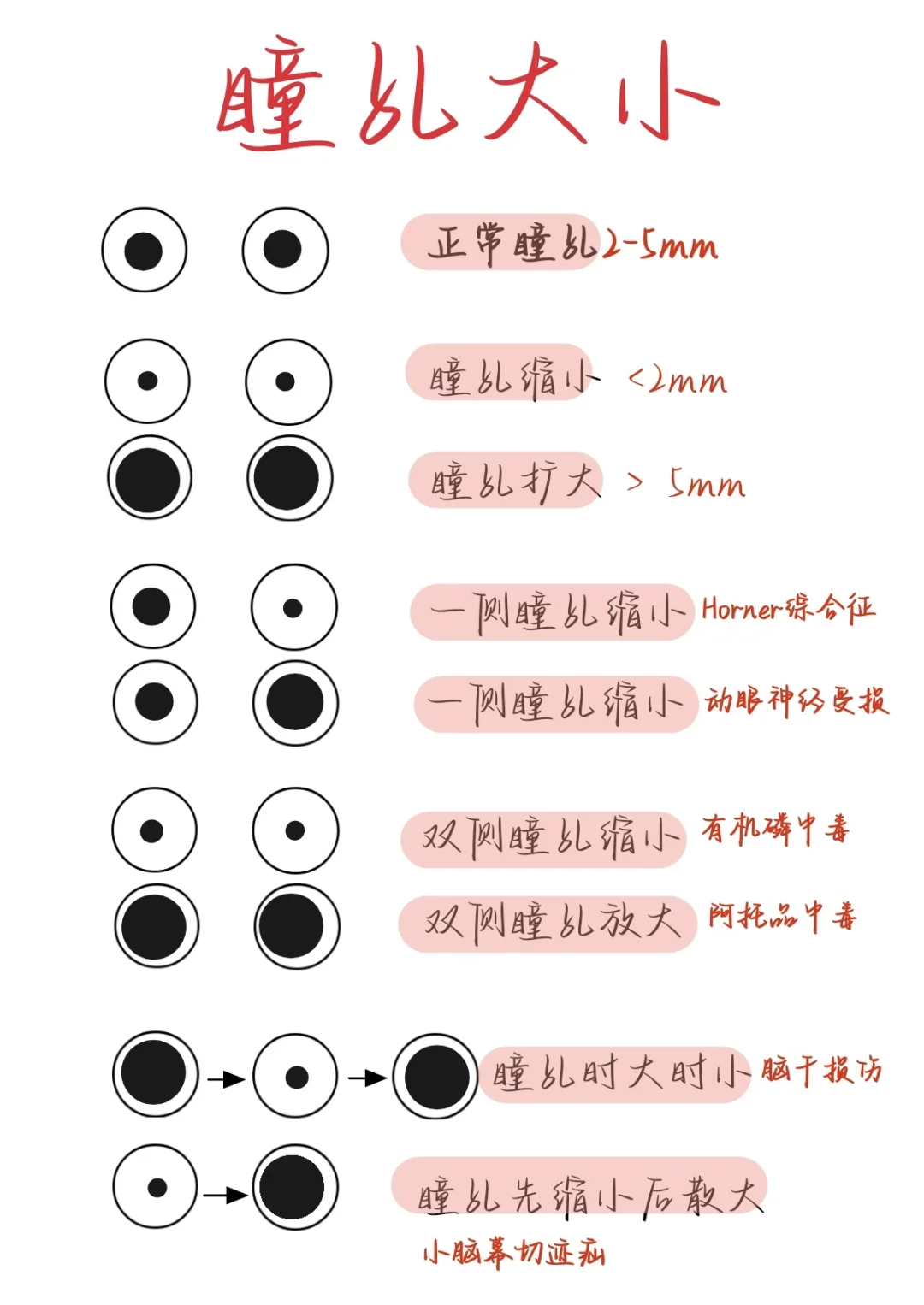 医学生笔记——瞳孔大小