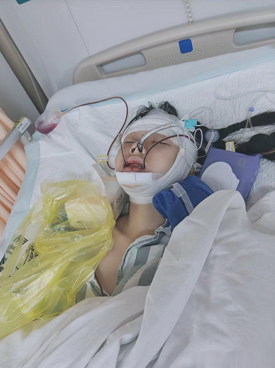 复活！手术做了四五个小时​一脸都是血点子，​肿得像只蜜蜂修勾​经鼻气管插管感觉鼻