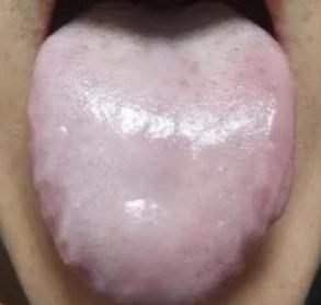 身体困重、大便黏腻？多半是湿气在作祟！舌头能直接暴露湿气类型，下面教你通过舌象快