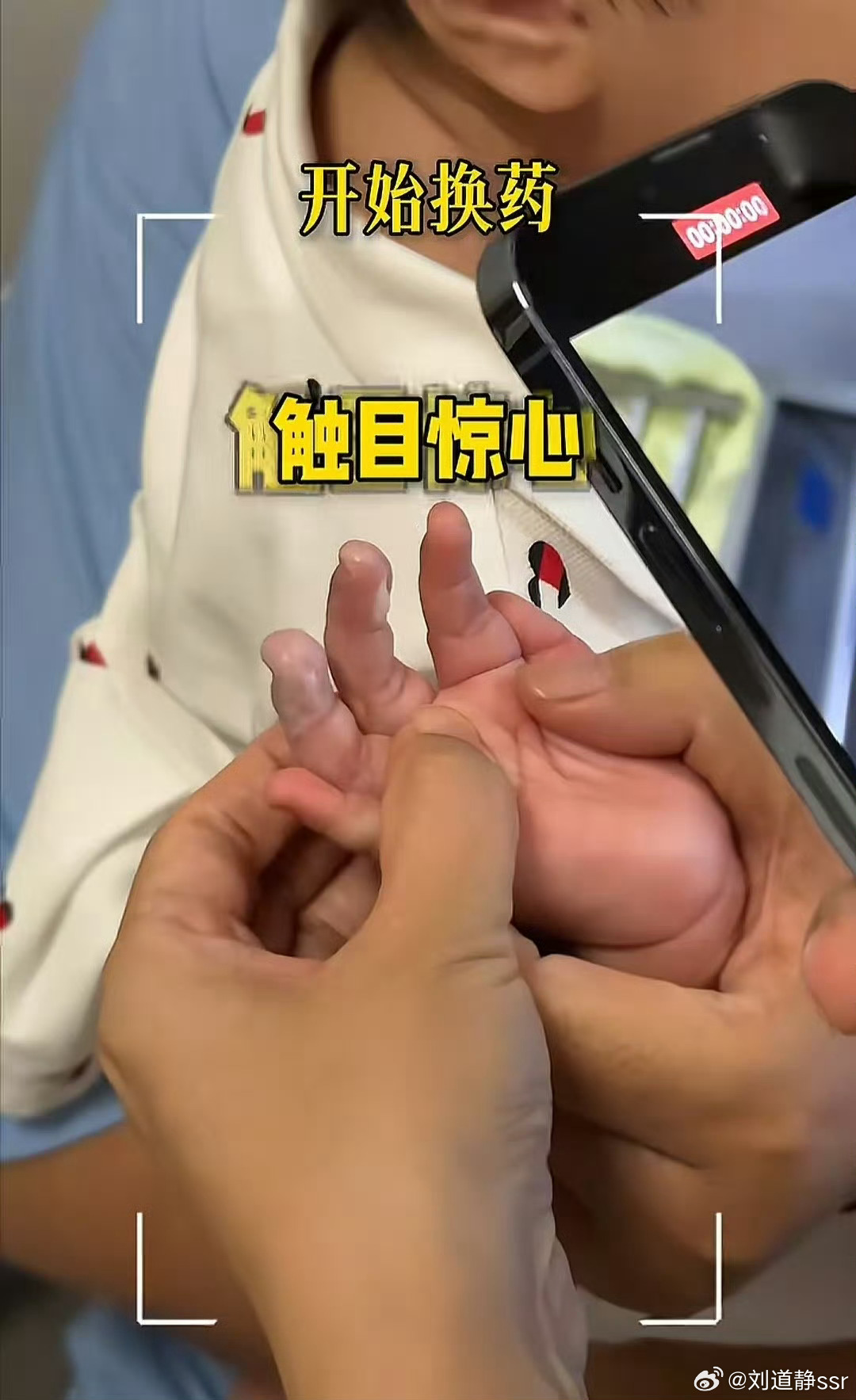 张纪中小女儿被保姆烫伤这小宝宝真可怜呀！还这么小就被烫伤了，唉！这保姆这么不小心