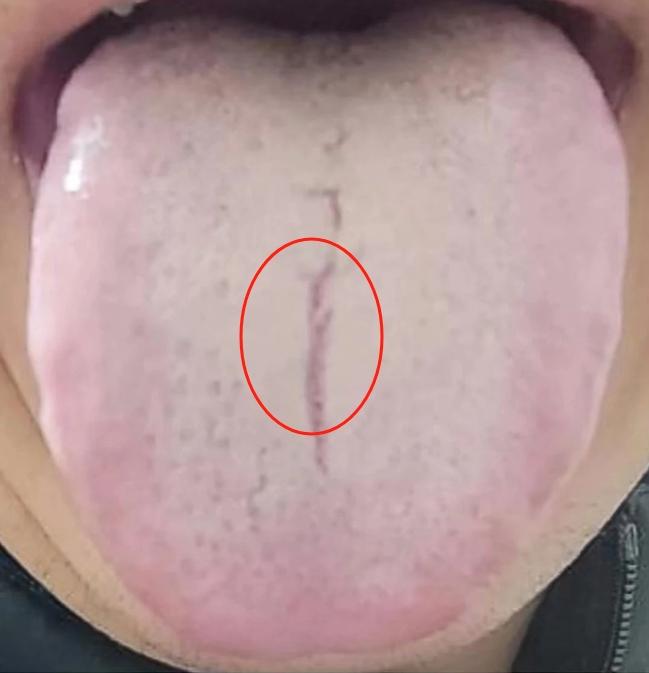 湿气太重，舌头会有裂纹。
先来说说正常的舌头是什么样子：一般呈淡红或淡粉色，表面