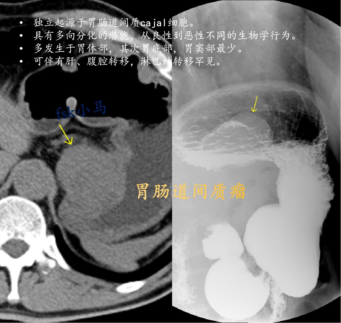 胃肠道间质瘤（GIST），是胃肠道间叶组织肿瘤，独立起源于胃肠道间质c...