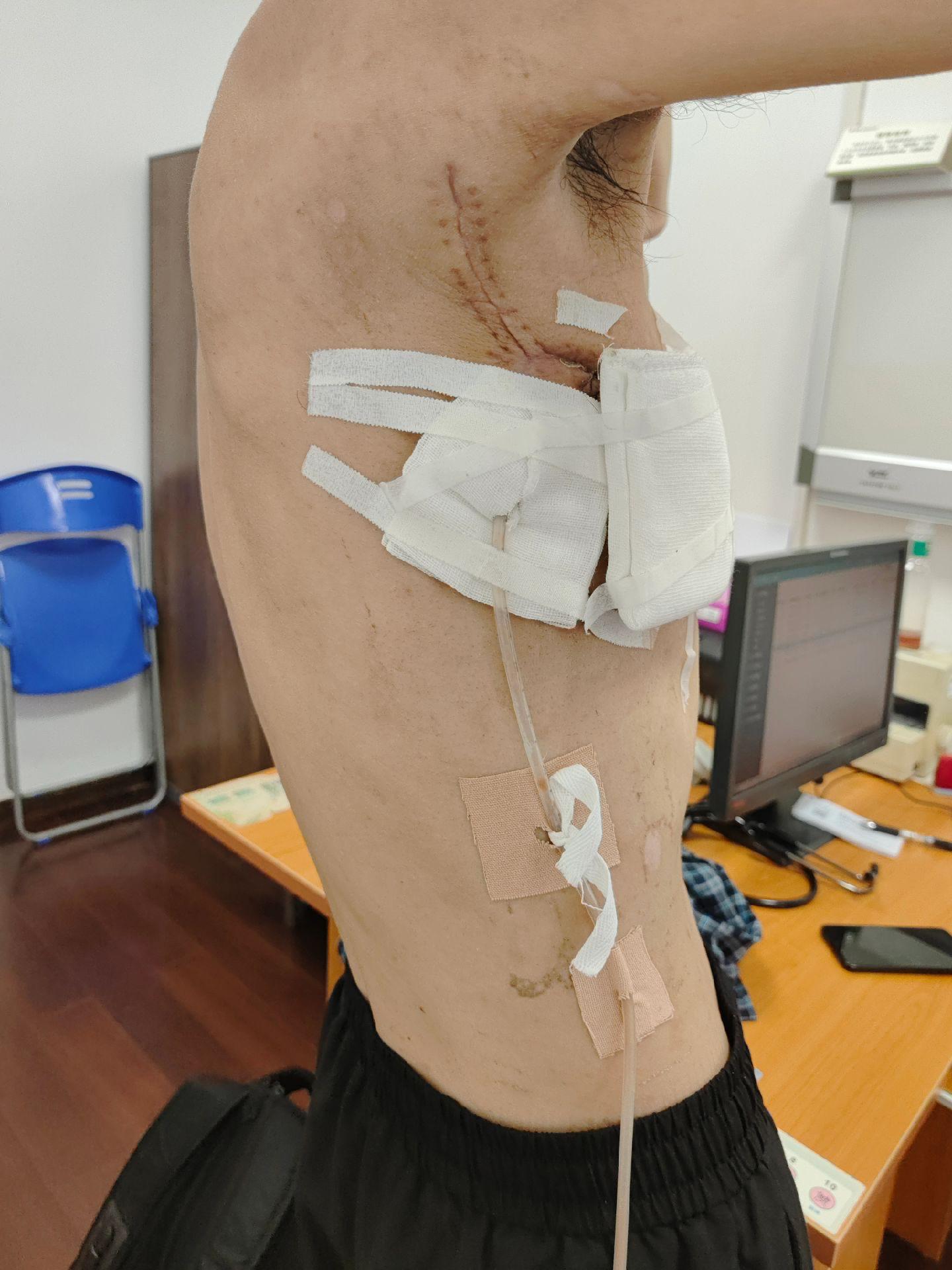 右侧脓胸支气管胸膜瘘巨大脓腔微创修复治愈。四川病友，右侧脓胸支气管胸膜瘘，巨大脓腔对我们是严峻挑战。微创修复，半年复查，完美治愈，不负厚望。