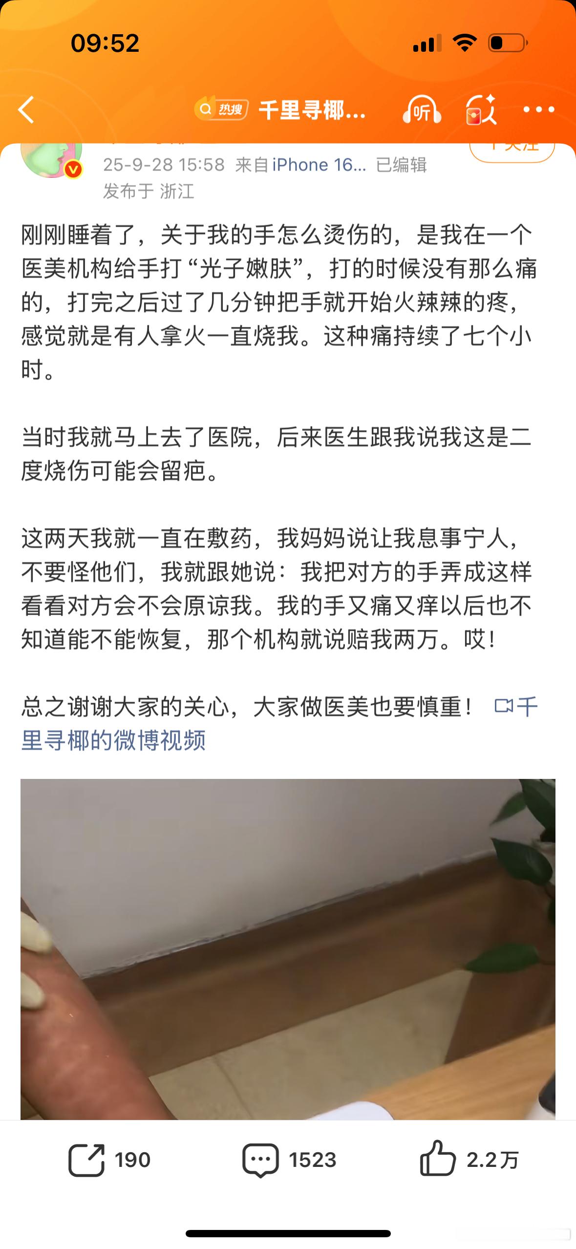 千里寻椰回应光子嫩肤二度烧伤千里寻椰回应被烧伤天哪，看着好吓人啊 ​​​