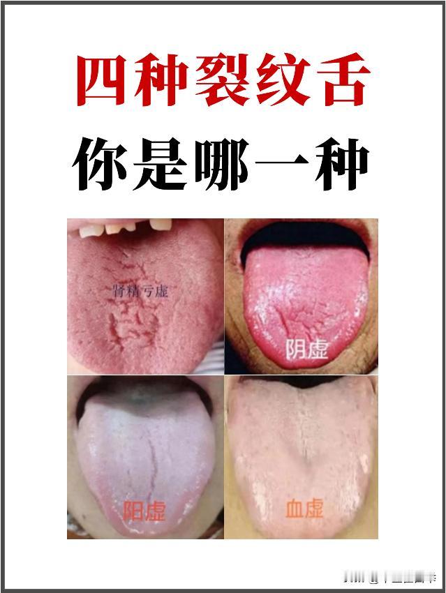 舌头有裂纹，身体要出大问题？别慌，看看你是哪种裂纹舌
#中医##养生##舌象#