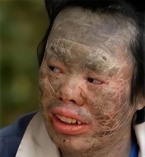 辽宁千山脚下的小村庄里，出了个让人毛骨悚然的“蛇人”——韩永波浑身长满蛇鳞般的片