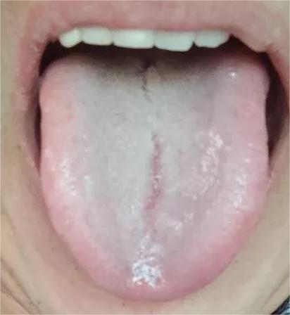 出现裂纹舌，不是软就是短，一定要注意！
 有裂纹舌，就一定要开始注意了，不是软，