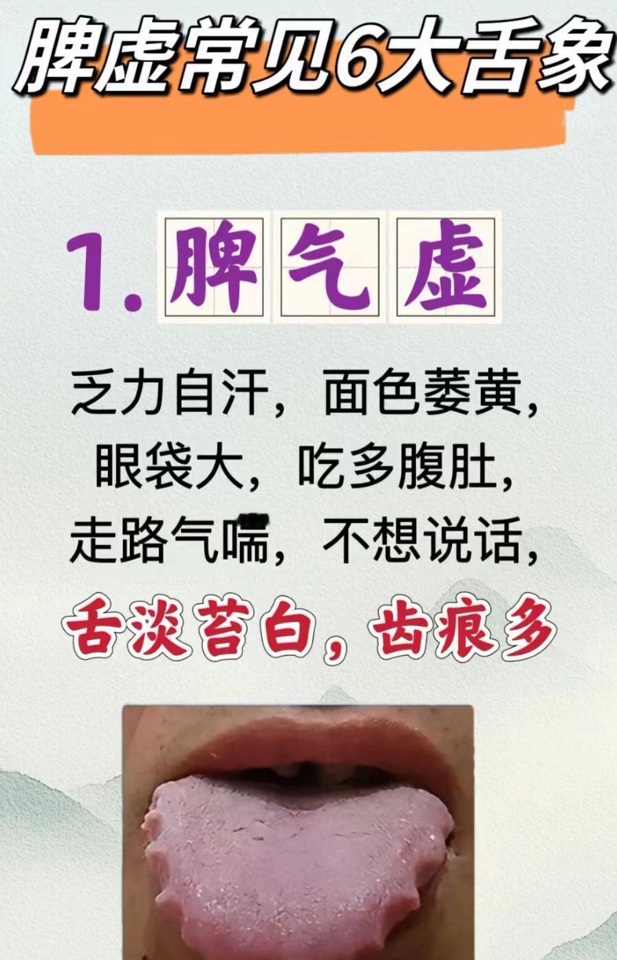 脾气虚 6大舌苔类型 看看你是哪种