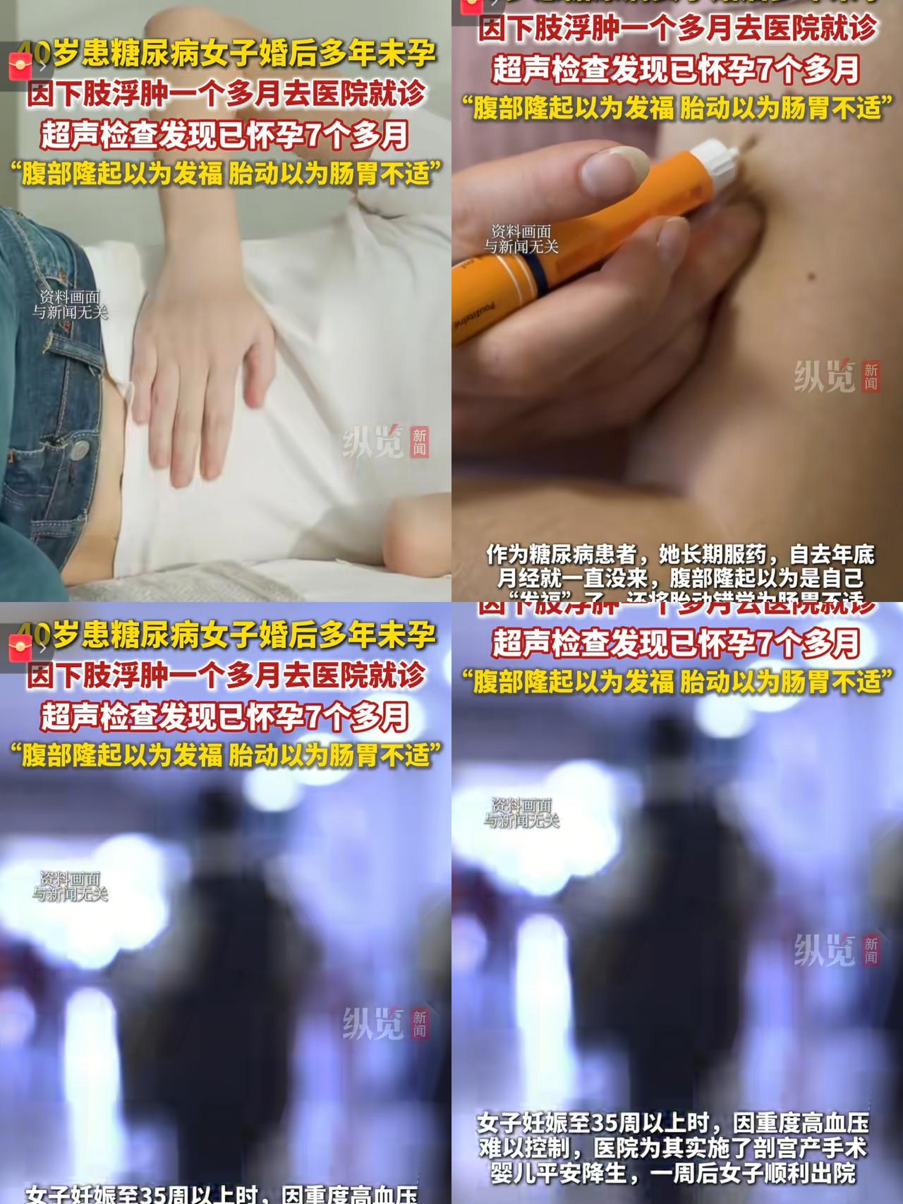 心大到离谱！杭州一40岁女子，下肢浮肿一个多月，一直以为是糖尿病让自己变胖，结果
