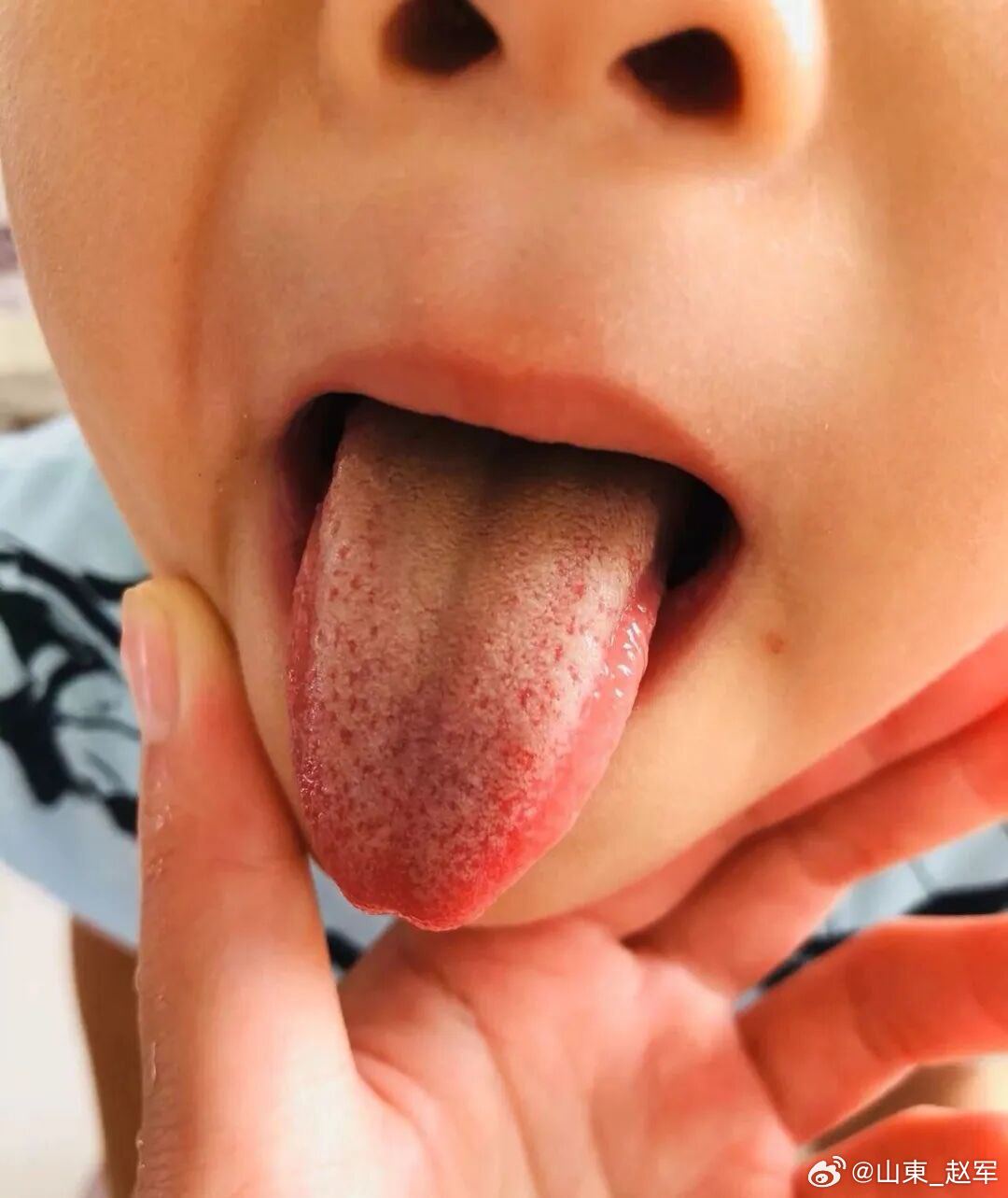 荨麻疹外洗诸方解析荨麻疹，中医称瘾疹、风疹块、风丹。起病倏忽，来去迅速，归之于风