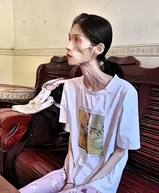 体重只剩35斤的花季少女，面容憔悴得像四十岁的人，连抬手的力气都没有。谁能想到，