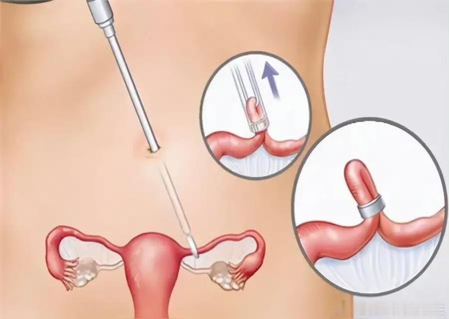 结扎手术后妻子怀孕，责任到底在谁？

近日，河北一名女子反映，她的丈夫做了输精管