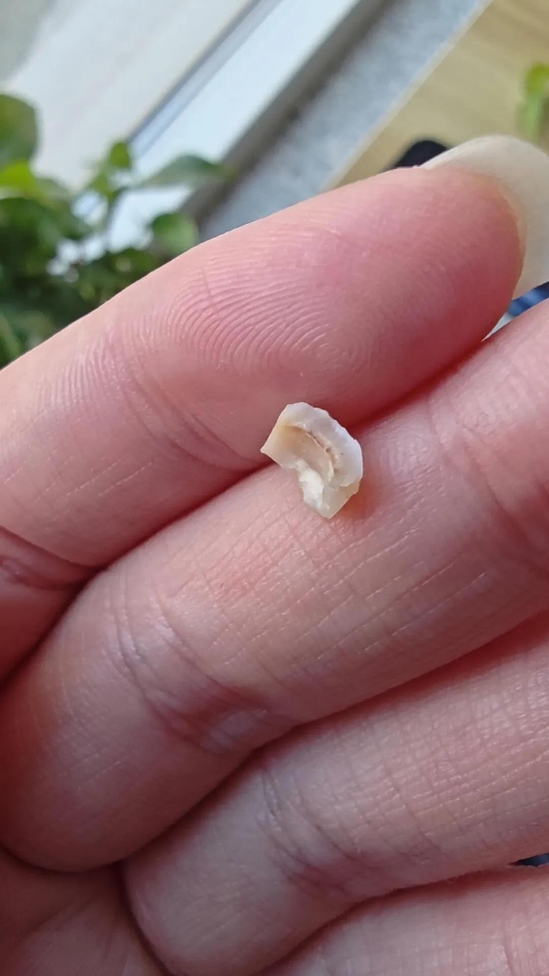 刚上班，牙齿掉了。
最里边的老牙有龋齿，几年前就补好了，照镜子半天也没看出来是哪