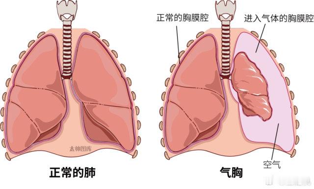 什么是爆肺 跟气胸差不多，身材瘦的人比较容易得，简单的说就是肺漏了，气漏在了胸腔