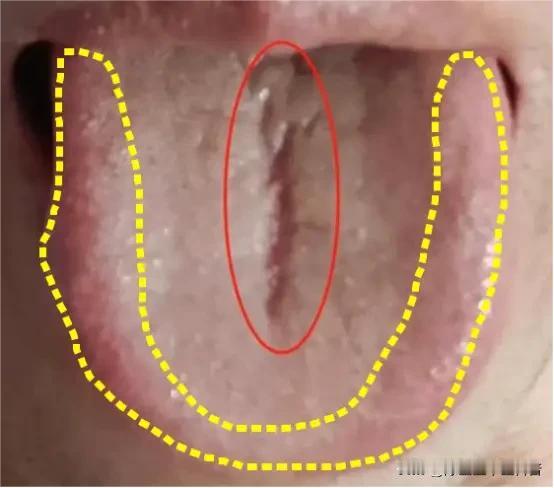 肝郁化火舌象别乱调！三步走，10天清肝火、健脾胃、祛湿热
 
大家好，我是陈大夫