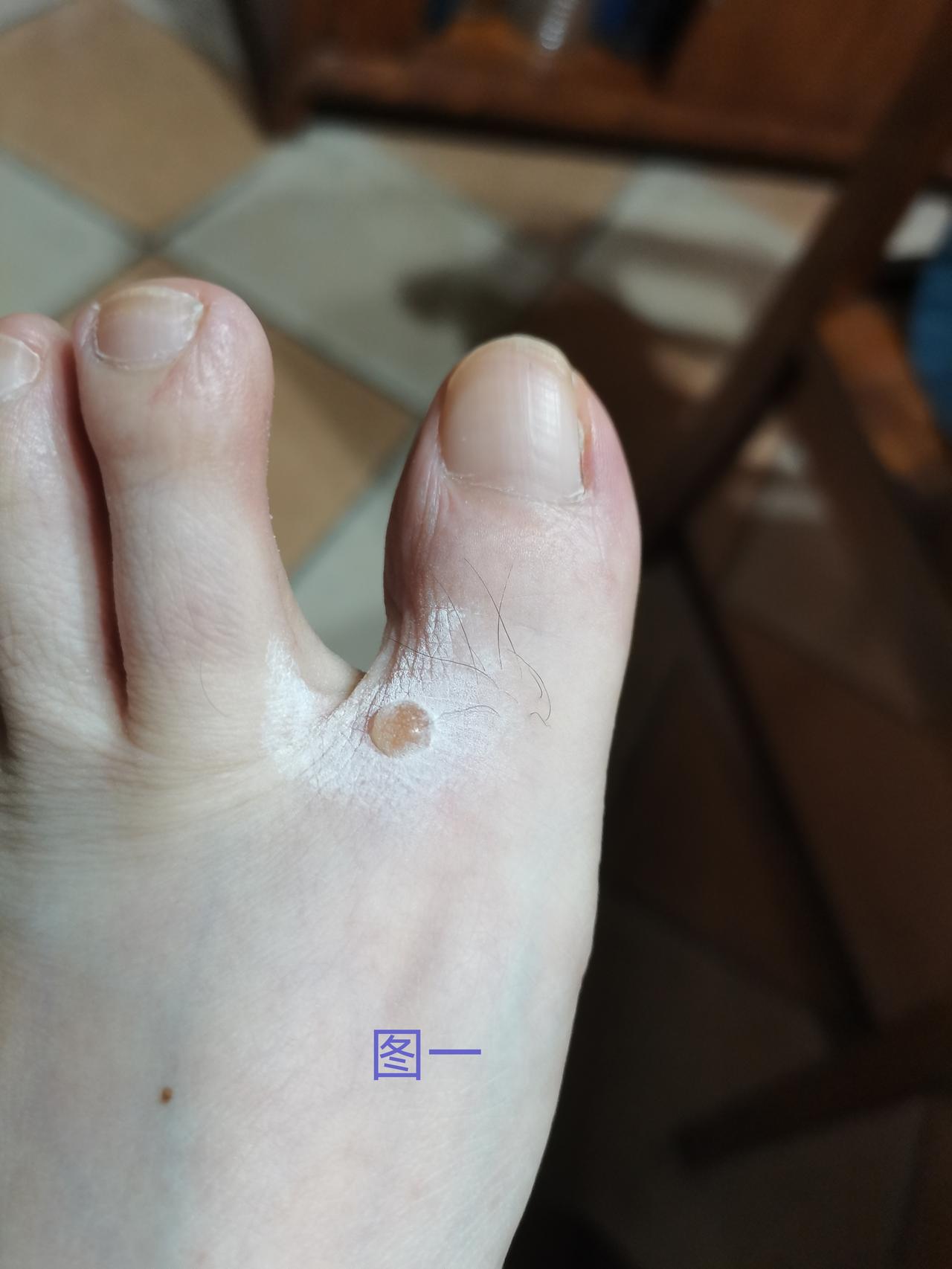 蠓虫叮咬过敏起泡好厉害，最好自己别乱动。

最初只是一个小红点，偶尔有点痒，后面