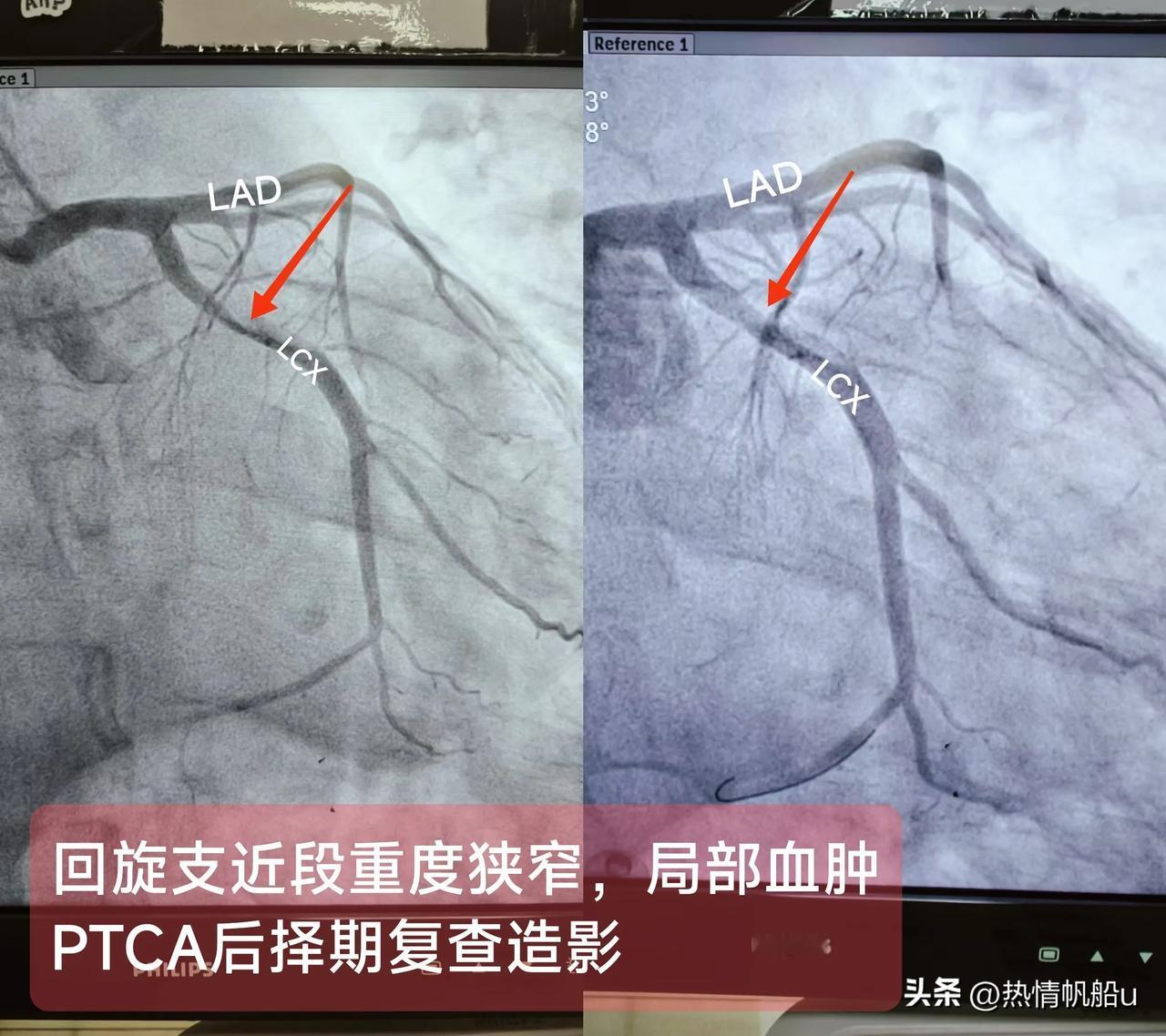 急性ST段抬高型心肌梗死
（回旋支近段重度狭窄，局部血肿）
概念：回旋支与前降支