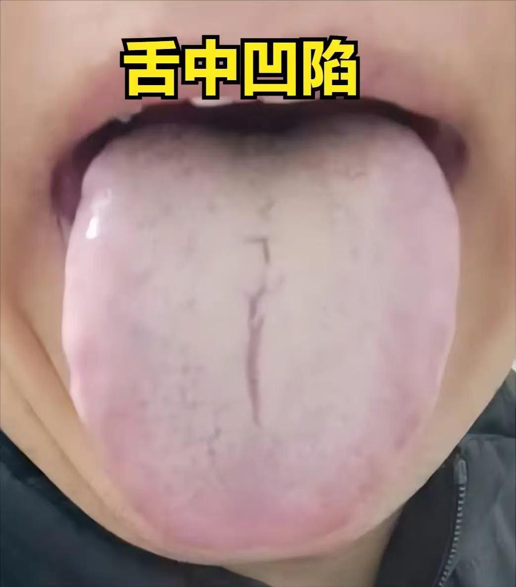 脾一虚，命难长，调理脾虚最快的两条路。舌中凹补中益气丸，舌中凸木箱顺气丸

脾是