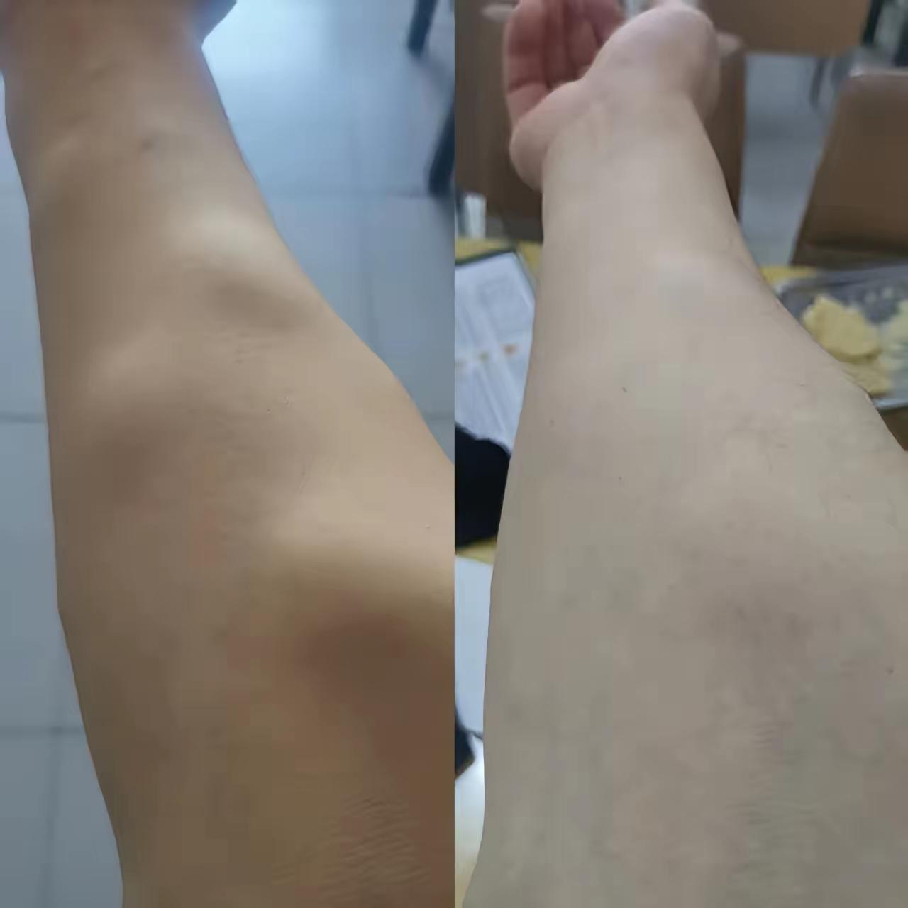 脂肪瘤最好的治疗办法就是传统手术切除，吃出来的毛病，喝了几个月的中药也毫无效果，