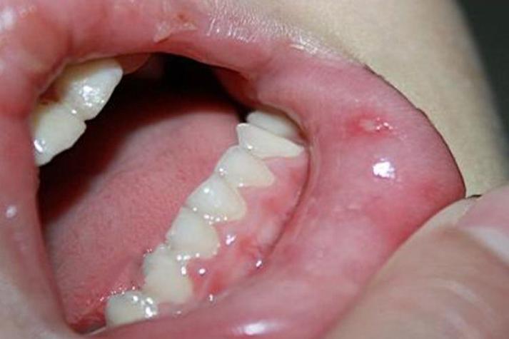 胃部有癌，嘴巴先知？嘴巴一旦出现5种异样，胃癌或已悄然临近

不少人对胃癌的印象