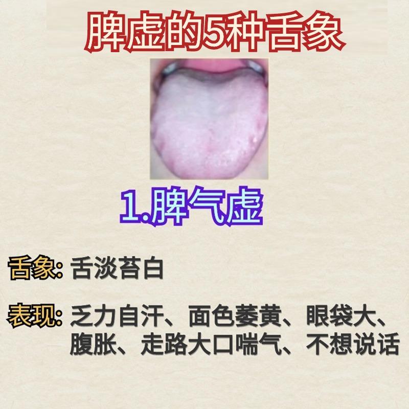 脾一虚，人就废了一半，脾不好的5种表现及舌象。