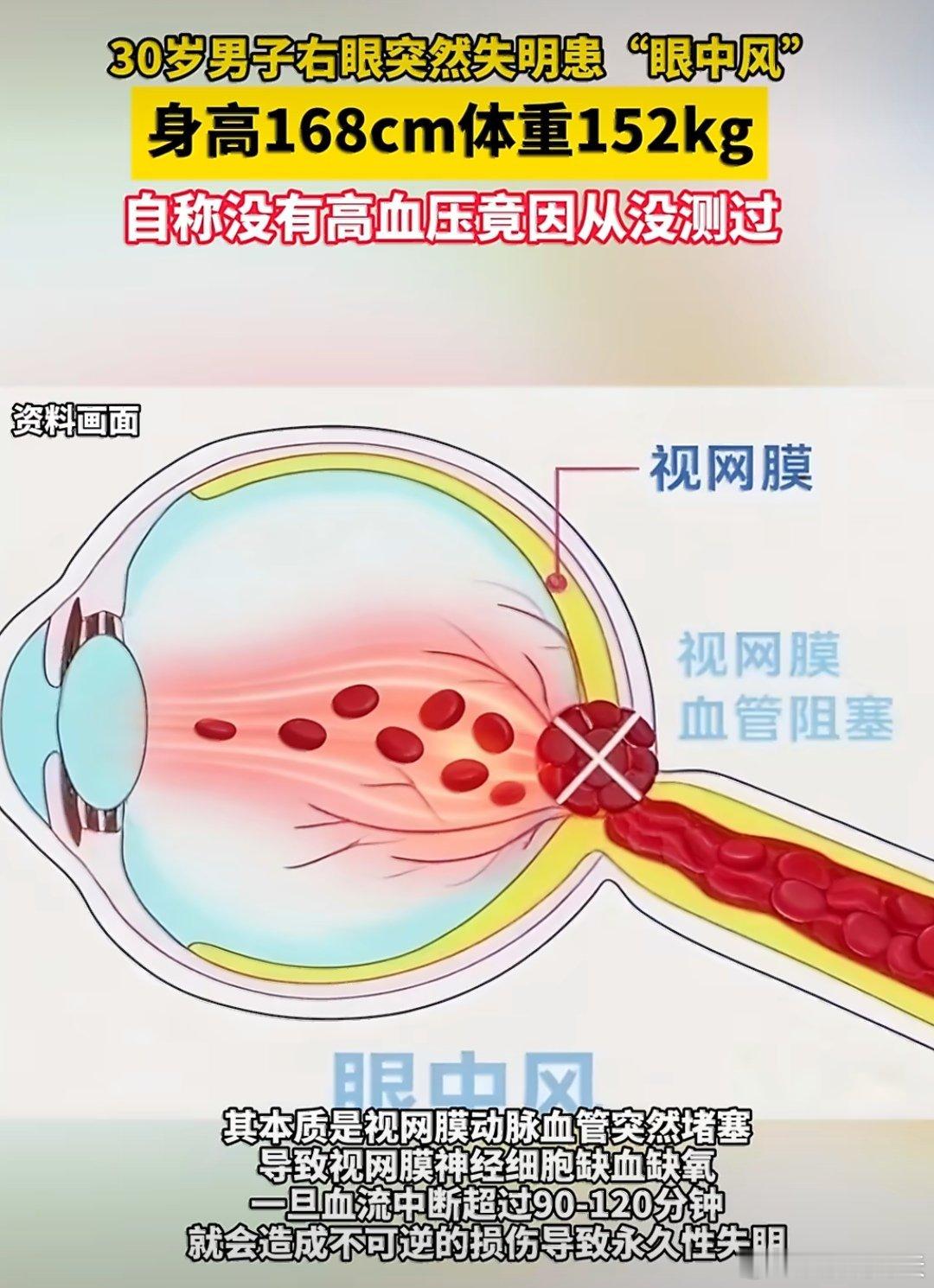 30岁男子右眼突然失明体重达304斤这个确实有点可怕啊，体重重达304斤，说自己
