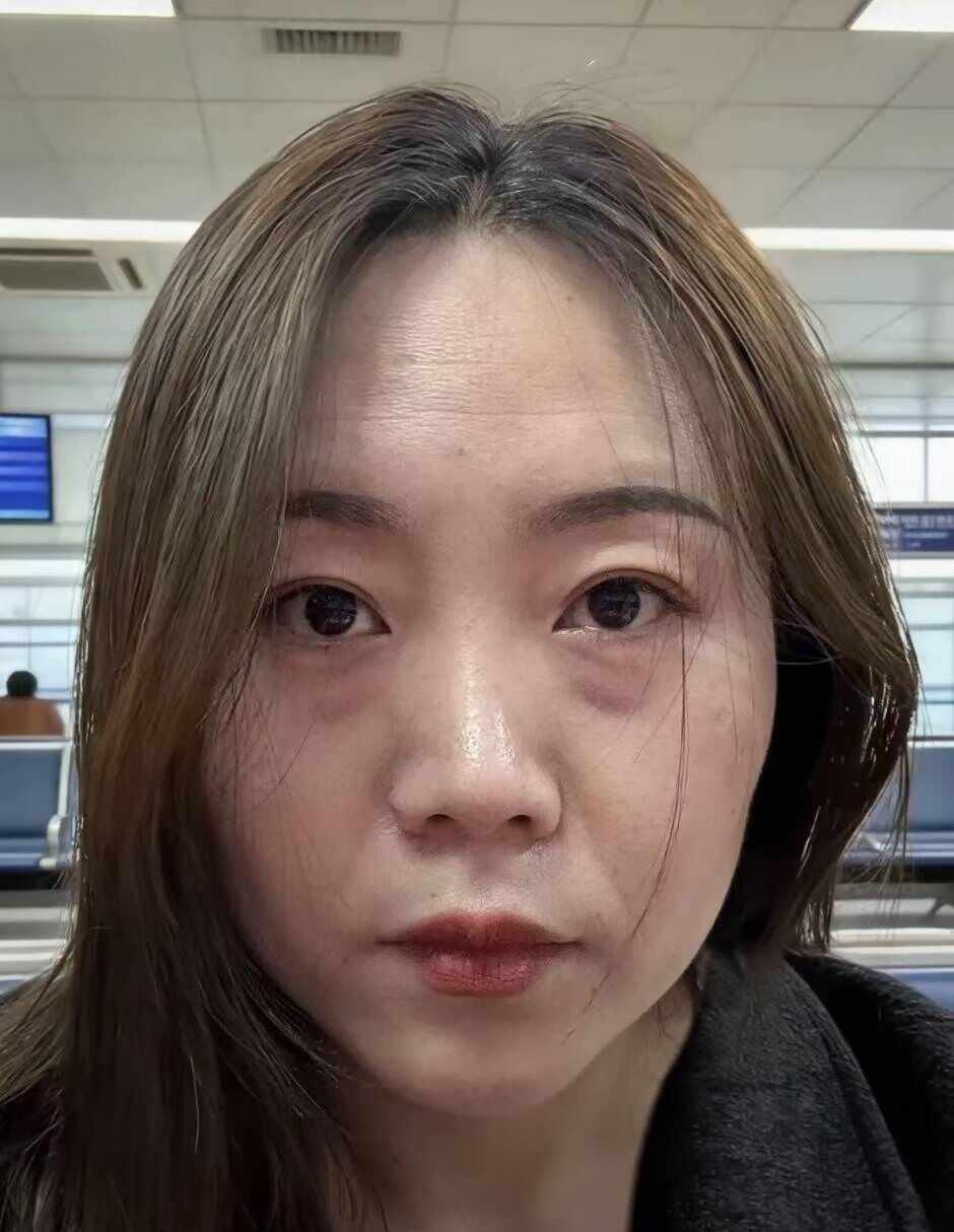 生娃真的太伤脸了，泪沟法令纹一下子就冒出来还贼深，看着特别憔悴。现在刚满一周，明