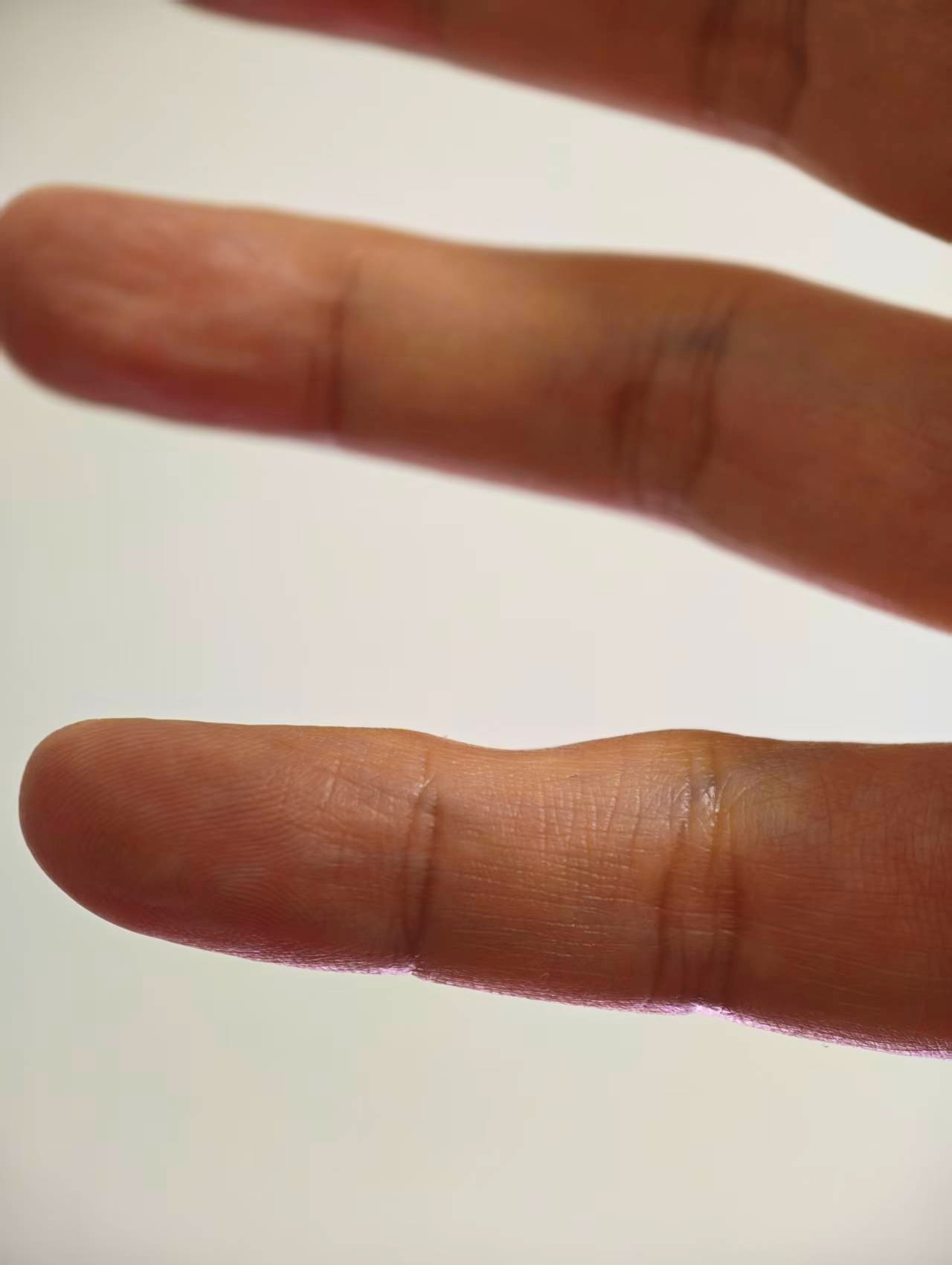 长期用小拇指托手机的后果看了一下我的左右小拇指，都是重度受害者